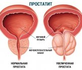 Что такое простатит